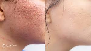 Before and after Acne scars treatment