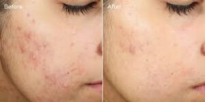 Acne scar resurfacing treatment, a famous method to get a better skin again