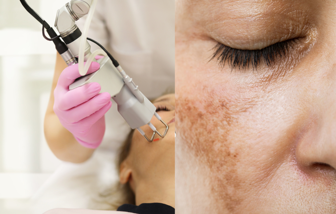 Hyperpigmentation from Laser Treatment