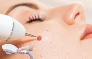 Benefits of laser treatment for skin tags