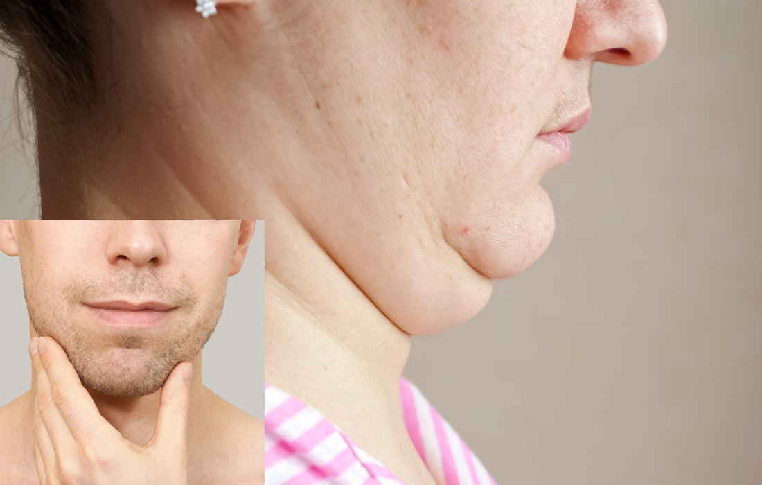 how much is chin liposuction uk