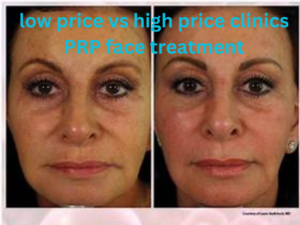 low price vs high price clinics prp face treatment